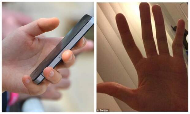 Смарт-мизинец: у пользователей смартфонов все чаще встречается деформация пальца