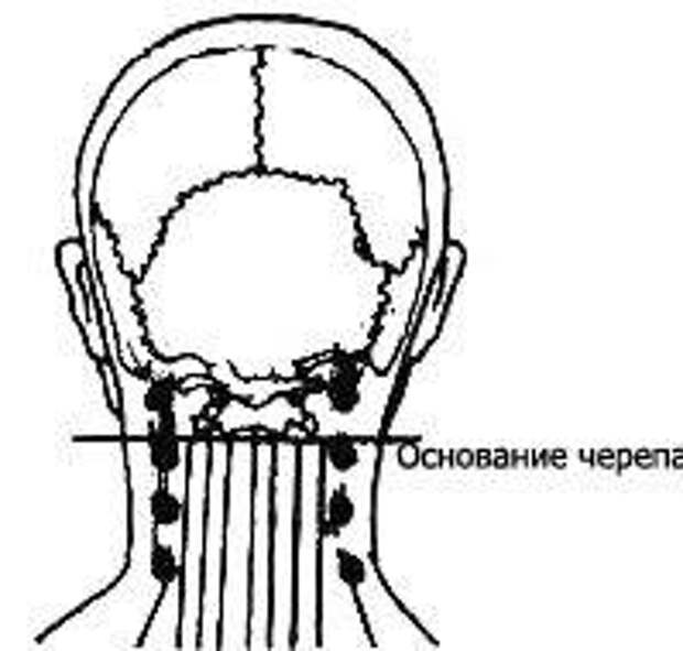 Причины боли у основания черепа. Боль в затылке у основания черепа причины. Точка у основания черепа.