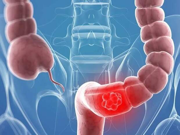 Эпидемия 30-летних: врачи бьют тревогу из-за страшного диагноза