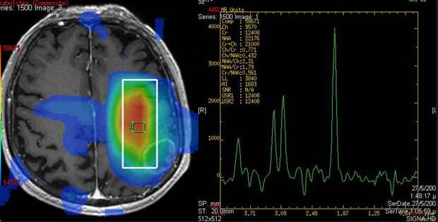 МР-спектроскопия (MRS): Неинвазивный биохимический анализ тканей