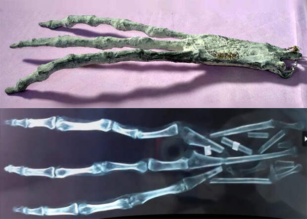 Изображение и рентгенограмма трехпалой руки