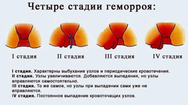 Лечение геморроя - рецепты мы не скроем. Очень средства ценные, в лечении отменные!