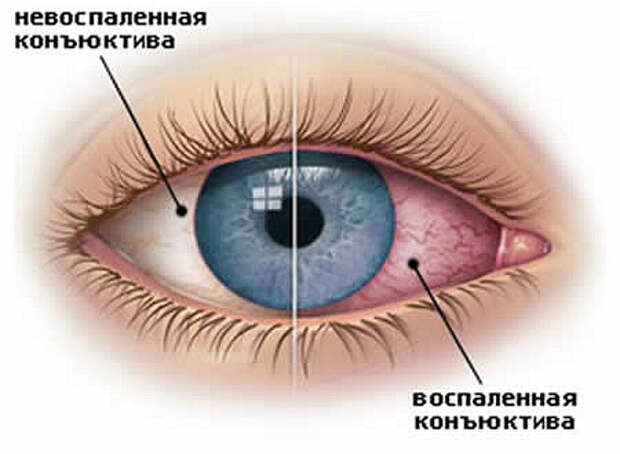 Как лечить коньюктивит в домашних условиях Прежде, чем непосредственно приступить к лечению, стоит убедиться, что это именно конъюнктивит.
