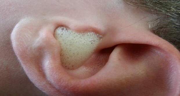 Не используйте ватные палочки: врач обнаружил наиболее эффективный способ чистки ушей
