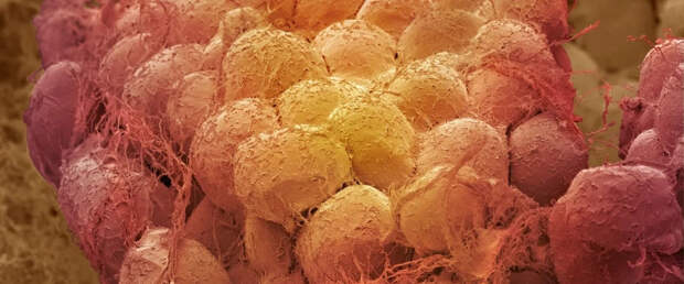 Дефицит бурого жира в организме повышает риски развития гипертонии