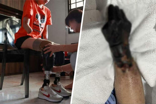 LADBible: малайзийка лишилась рук и ног из-за инфекции