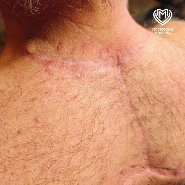 Московские врачи удалили липому размером с арбуз