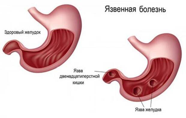Лечение язвы желудка