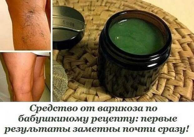 Бабушкин рецепт от варикоза: результаты очень скоро