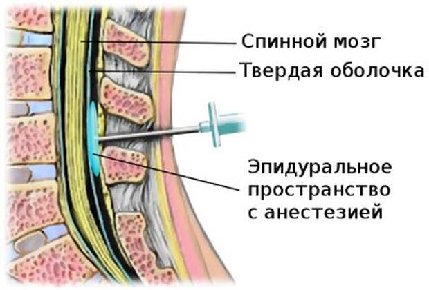 Эпидуральная блокада - временное обезболивание, но не устранение причины заболевания!