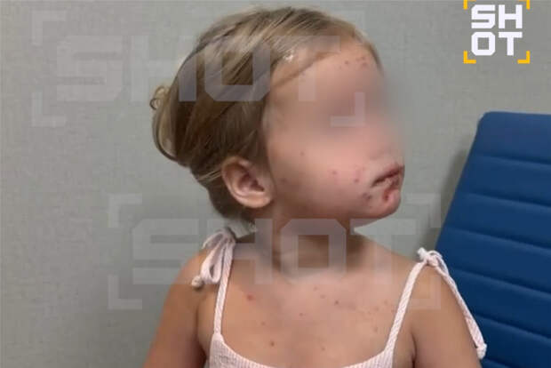 Трехлетняя девочка заразилась кожной инфекцией после укуса комара и купания на Бали