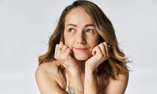 Когда кожа теряет цвет: правда о витилиго — болезни, от которой страдают даже знаменитости