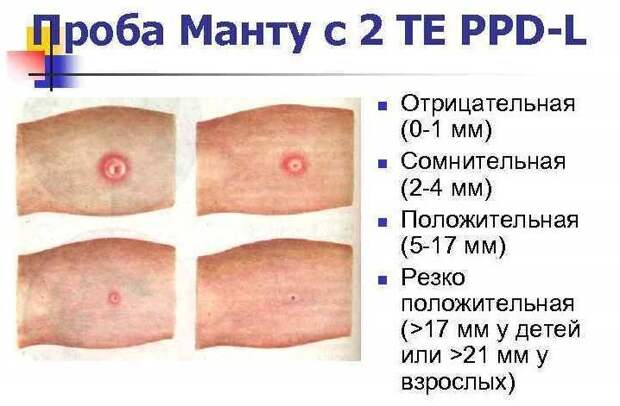 Фотография: Братство, объединенное шрамами: от каких болезней делают прививки №5 - BigPicture.ru