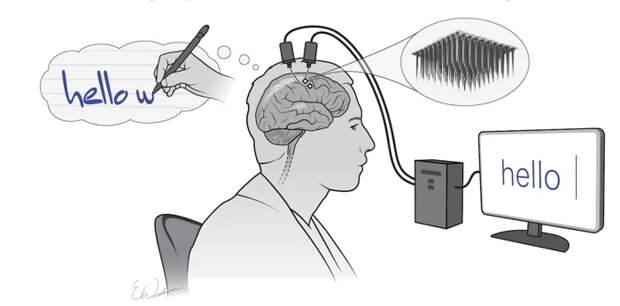 Мозговой имплант перевел мысли парализованного человека в текст с точностью 94%