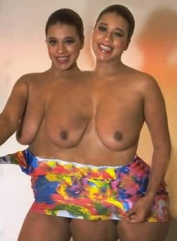 Siamese twins naked - 🧡 Фото Голых Обнаженных Siamese Twins.