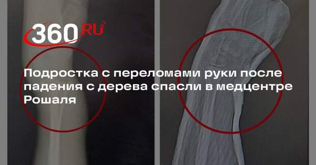 Подростка с переломами руки после падения с дерева спасли в медцентре Рошаля