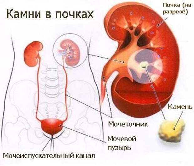 песок в почках (461x395, 36Kb)