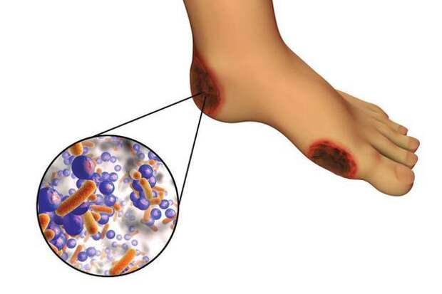 Диабетическая стопа: симптомы и лечение, стадии диабетической стопы, уход зав ногами при сахарном диабете