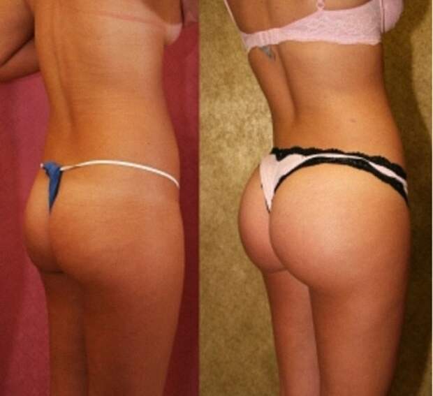 buttocks-implant