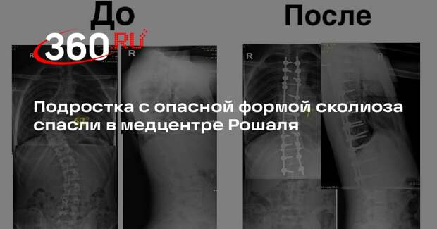Подростка с опасной формой сколиоза спасли в медцентре Рошаля