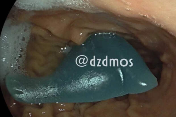 Московские врачи достали силиконового дельфина из желудка 5-летнего ребенка