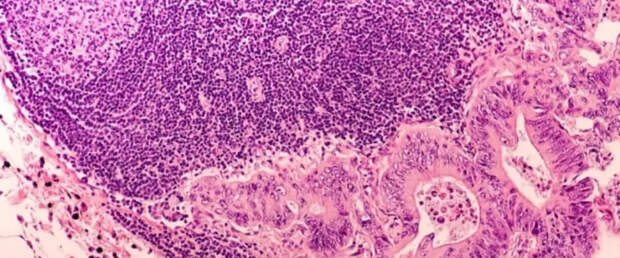 Ученые нашли фермент, усиливающий иммунитет против рака