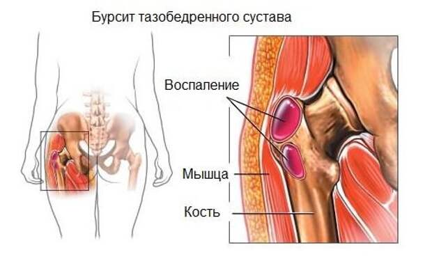 Лечение бурсита народными средствами: применяем отвары, компрессы и настойки в домашних условиях, народная медицина бурсит. Лечение бурсита народными средствами: применяем отвары, компрессы и настойки в домашних условиях, народная медицина бурсит.