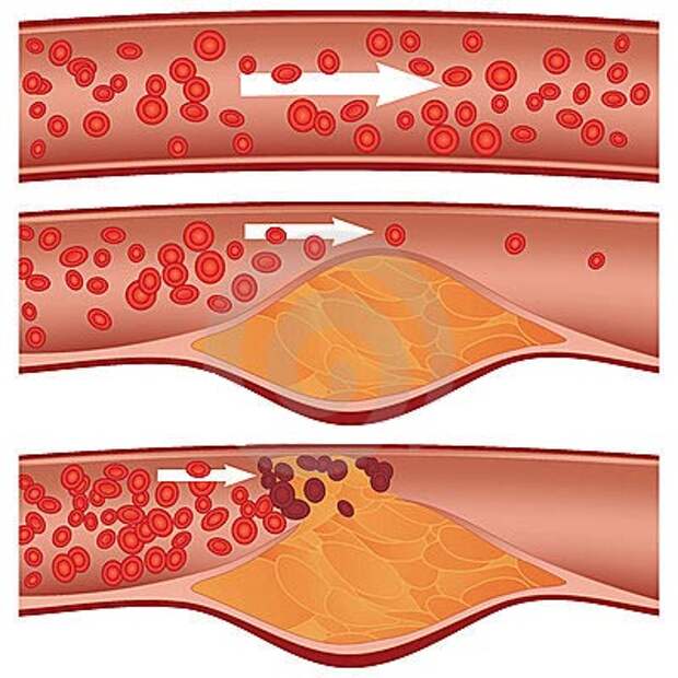 Атеросклероз сосудов 