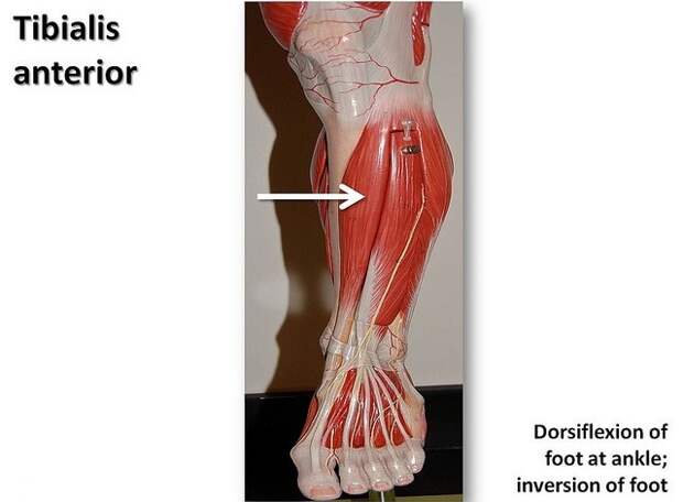 Shin Splints