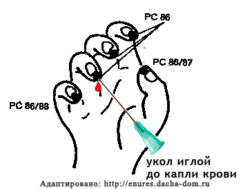 инсульт неотложная помощь pc86 ши сюань  