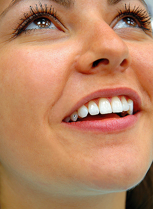 Скайсы на зубы фото женщины